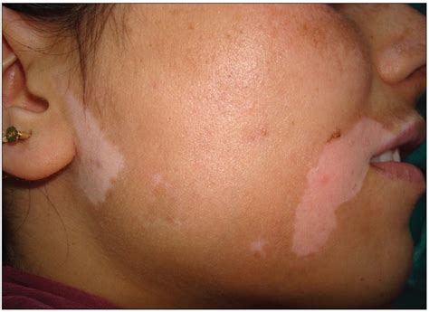 Preoperative picture of vitiligo lesions on face | Download Scientific ...