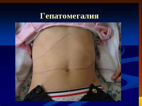 Гепатомегалия: что это такое, что означает диагноз, симптомы и лечение