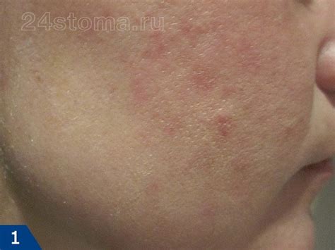Как убрать следы от прыщей на лице – красные пятна, шрамы и рубцы