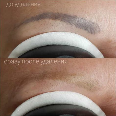 Что такое ремувер для удаления татуажа бровей фото