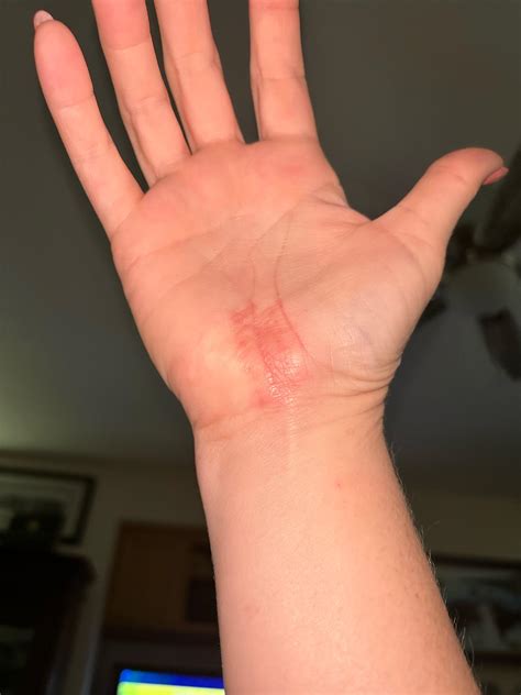 1 month post op. Incision area still sore. Normal? : r/carpaltunnel