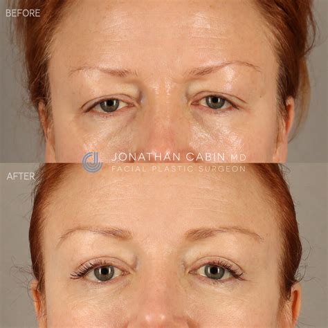 laser upper eyelid lift