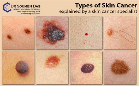 Types of Skin Cancer explained by a skin cancer specialist