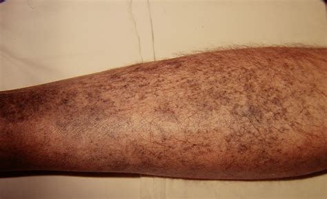 thyroid pigmentation  thyroid black pigmentation minocycline