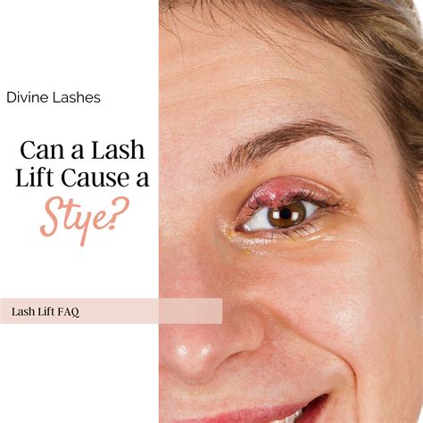 Swollen Eyelid Treatment Stye at George Delano blog