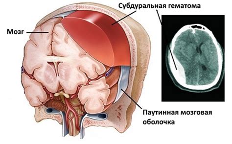 Хроническая и острая субдуральная гематома головного мозга и ...