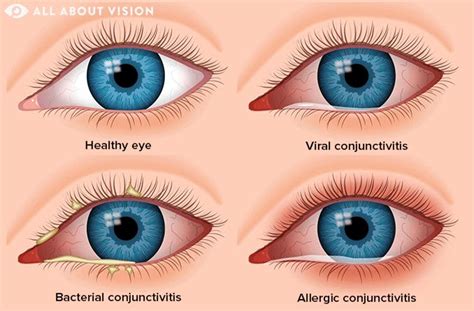 Pink Eye (Conjunctivitis) Treatment and Diagnosis