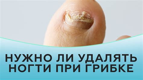 Нужно ли удалять ногти при грибке - YouTube