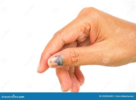 Bruising On The Thumb Nail By Door Lock Accident Ep02 Royalty-Free ...