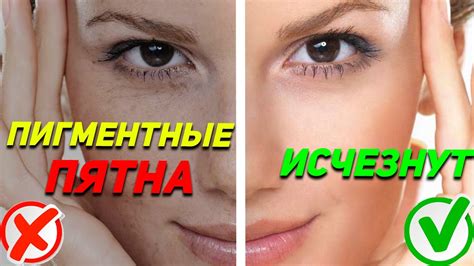 ПРИЧИНЫ ПИГМЕНТНЫХ ПЯТЕН И ИХ РЕШЕНИЕ / Психосоматика - YouTube