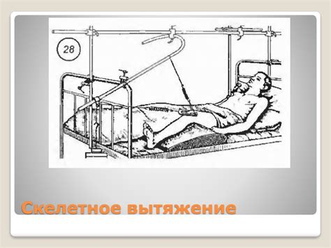 Переломы бедренной кости - презентация онлайн