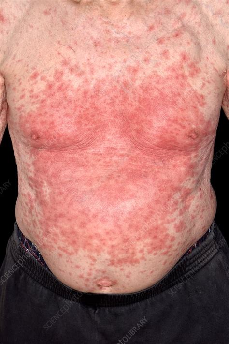 Skin Rash Treatment Allergic Reaction at Jose Orr blog