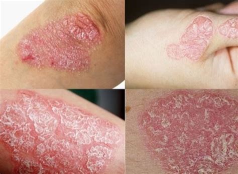 penyakit kulit  homecare