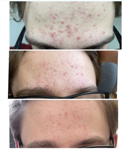 Forever Clear® BBL Acne Treatments - Pure Reflection
