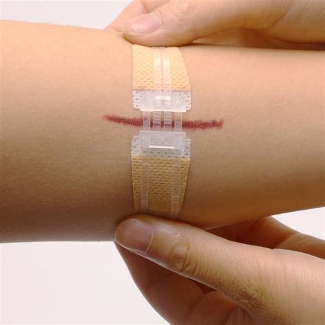 Longmed Emergency Wound Closures - Butterfly Adhesive Bandages - 3