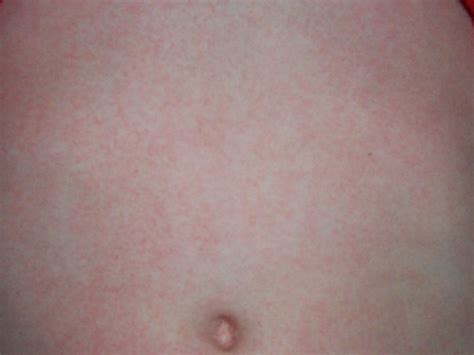 FERTZ Dr Boda Mrta Skarltvrs torok Streptococcus Vrkp
