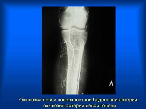 Аневризма дистального анастомоза БАБШ справа Баллонная дилатация