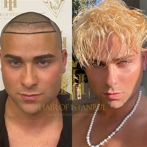 Before & After - Hair of Istanbul