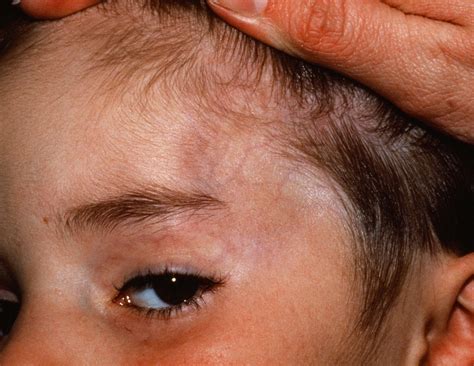 morphea haut sklerodermie bei kindern und jugendlichen dmlox
