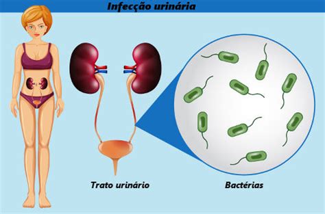 O Que Causa Infecção De Urina Na Mulher