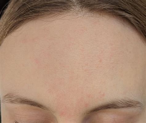 textured forehead dry greasy bumpy  rash racne
