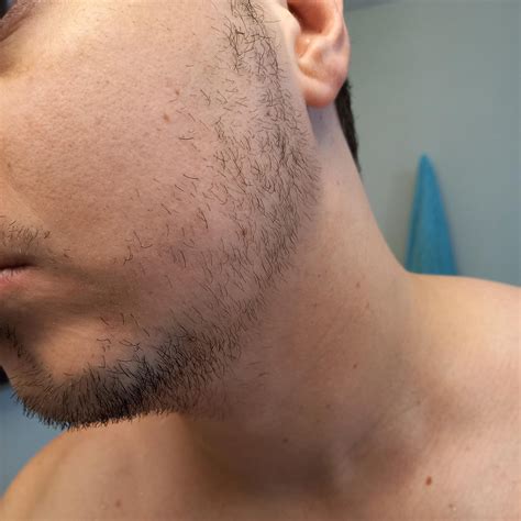Realistic slow/average gainer progress (~6 months). Beard loading
