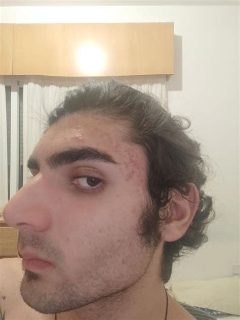 [Acne] Are those scars on the side of my forehead ? If not , how do i ...