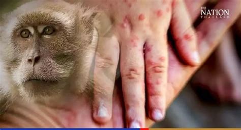 Affenpocken: 12 Personen in Quarantäne, Thailand