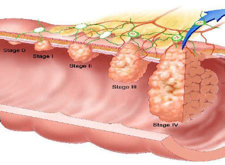 Colon Cancer Stages Diagram