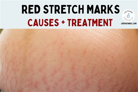 red stretch marks striae rubra    treat