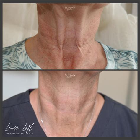 microneedling gallery explore stunning results luxe loft