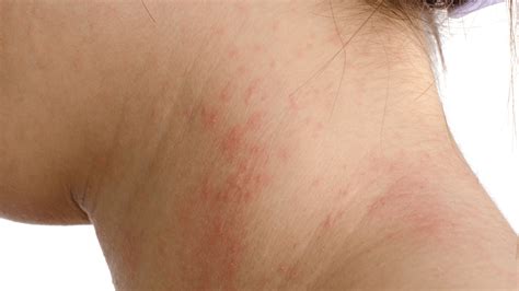 7 Types of Eczema: Causes, Symptoms, & Treatments | Gladskin