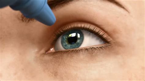 IMPLANT INTRAOCULAIRE - YouTube