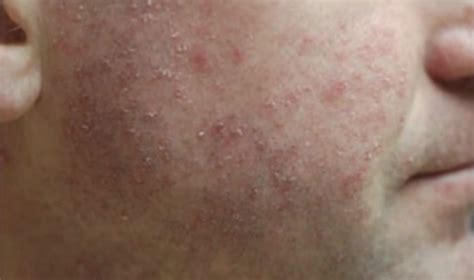 Antibiotic Rash Treatment