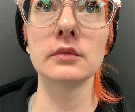 Upper Lip Lift | Dr. Joseph Spaniol | PSC Wichita