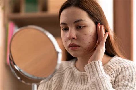 Как понять, когда прыщи исчезают: признаки и симптомы исчезновения прыща