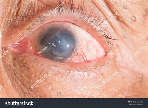 Close Phthisis Bulbi During Eye Examination Stock Photo 384263176 ...