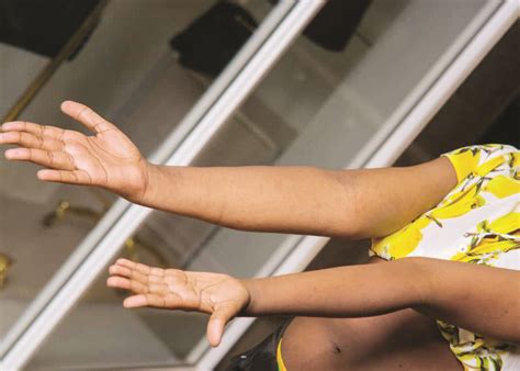 Health: Her right side grows faster than the left