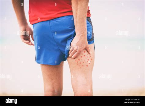 Body acne man scratching itchy pimples on back leg thigh -skin allergy ...