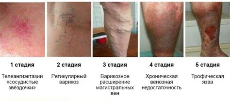 Ретикулярный варикоз: лечение, симптомы, методы диагностики | Домашний ...