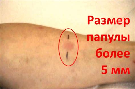 Реакция на манту у ребенка на фото