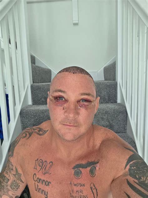 Rightguys - Day 4 recovery eyes can see better now absolutely zero pain