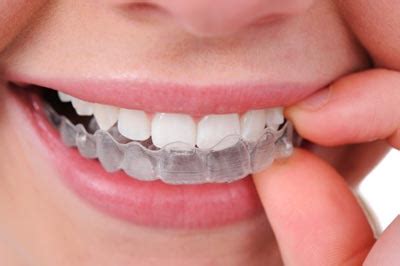 Clear Aligners For Teeth: Invisible Braces Cost, Treatment In India