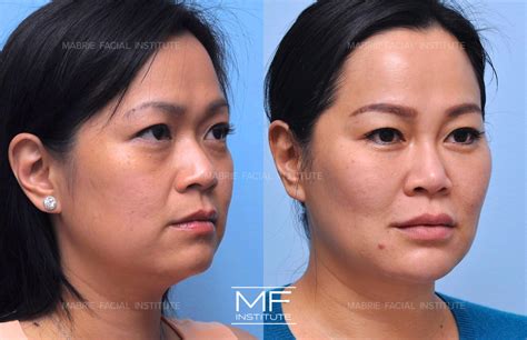 eye bags vs dark circle 11