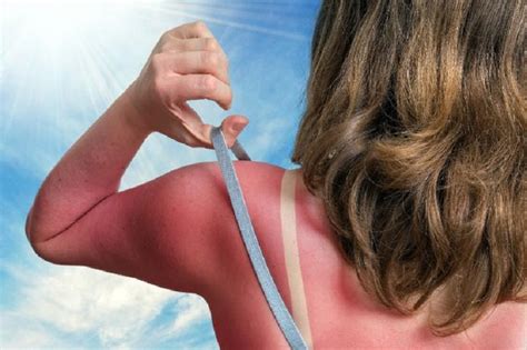 Queimado De Sol O Que Fazer - Queimadura de sol? Confira o melhor a fazer! – Unimed Cascavel – Blog