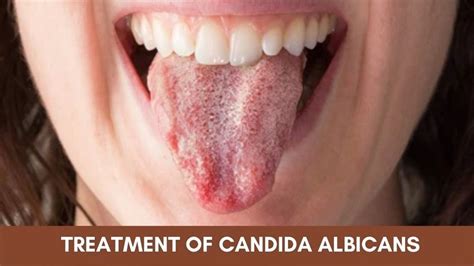 Candida Symptoms Swelling Lips | Lipstutorial.org