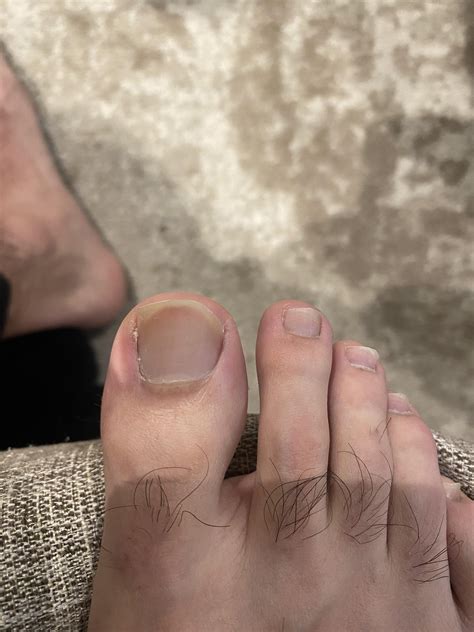 Any hope for me at this point? : r/Ingrown_Toenails