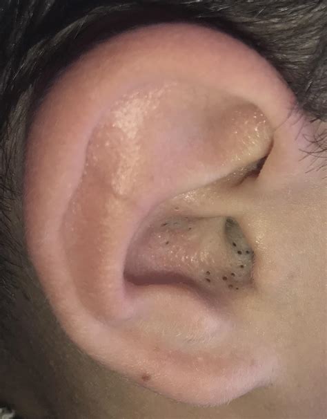 Watch Blackheads Being Removed From The Inside Of Someone's Ear Allure