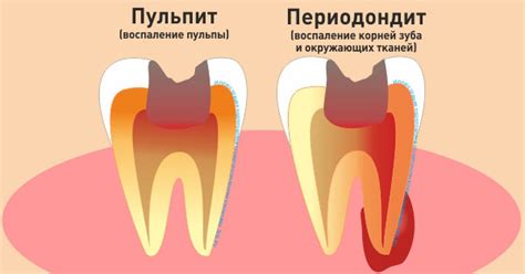 Лечение пульпита молочных зубов у детей недорого в клинике «СолоДент»