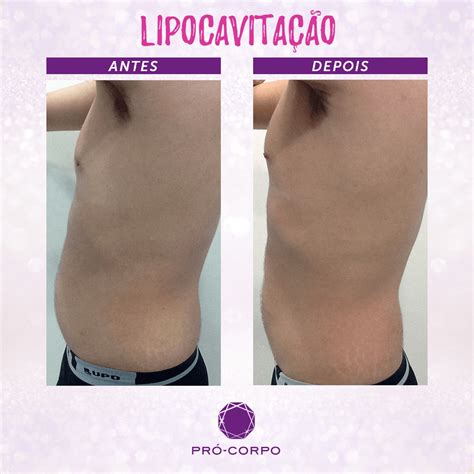Lipocavitacao Antes E Depois - Lipocavitação Antes E Depois Barriga - RETOEDU
